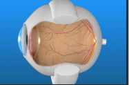 Scleral-Buckle